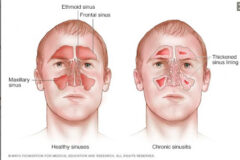 Mengenal Penyebab Sinusitis, Wajib Diobati dengan Operasi?